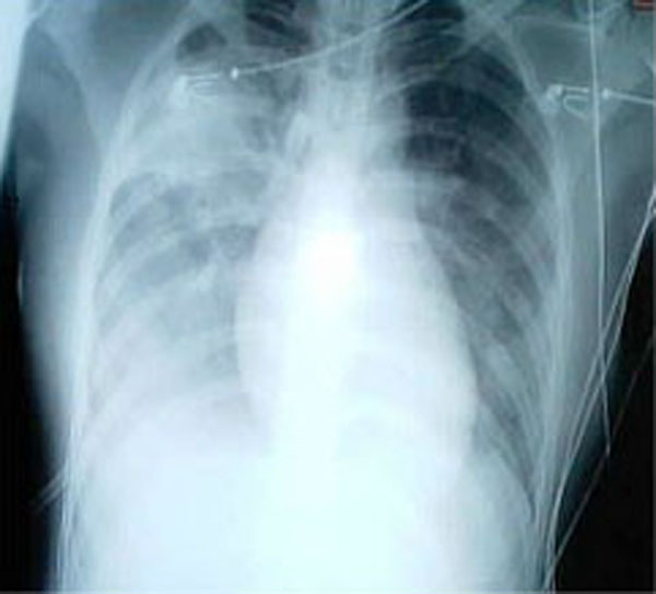 A chest X-ray of a patient with SARS