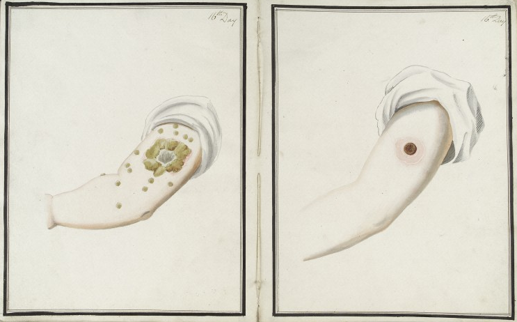 Comparison of smallpox (left) and cowpox (right) inoculations 16 days after administration
