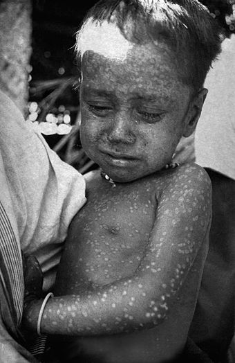 Smallpox symptom: rash